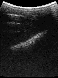 BCF Easi Scan Curve Calf Abnormal Lung Showing Area of Consolidation