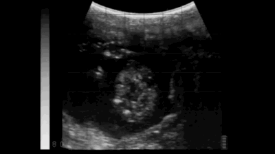 Fetus normal bovine 62 day bull calf BCF Easi-Scan