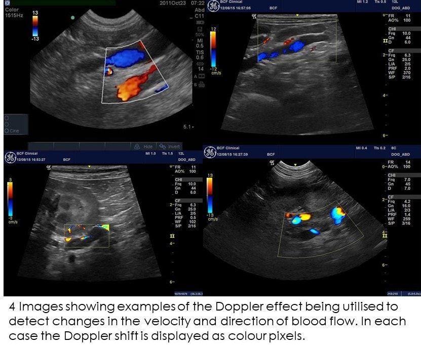 Doppler ultrasound explained