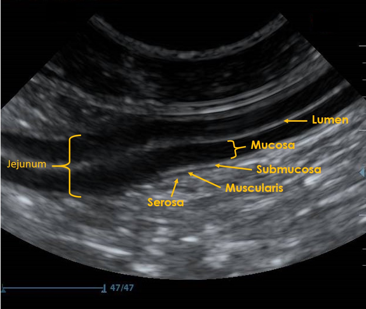 Ultrasonography of the gastrointestinal tract - GI tract