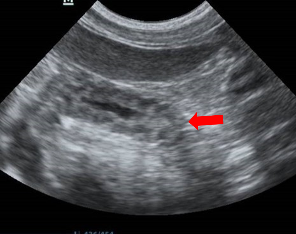 Ultrasonography of the gastrointestinal tract - corrugation