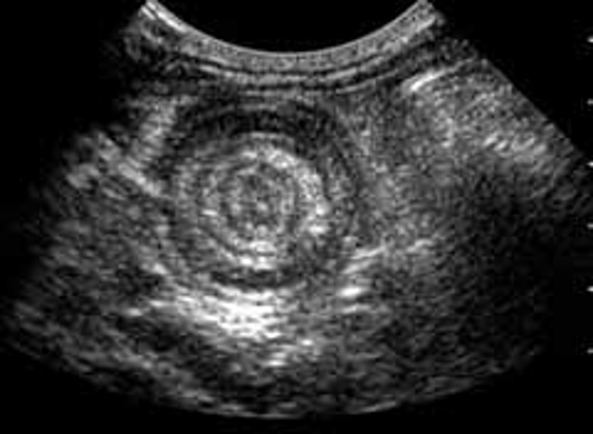 Ultrasonography of the gastrointestinal tract - intussusception