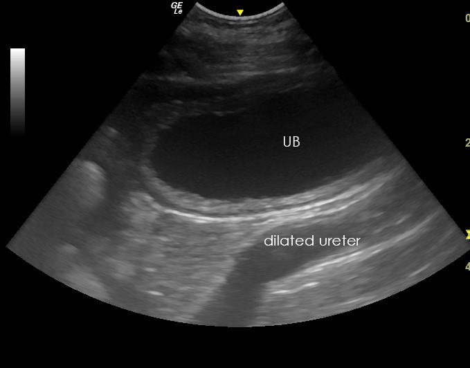 dilated ureter