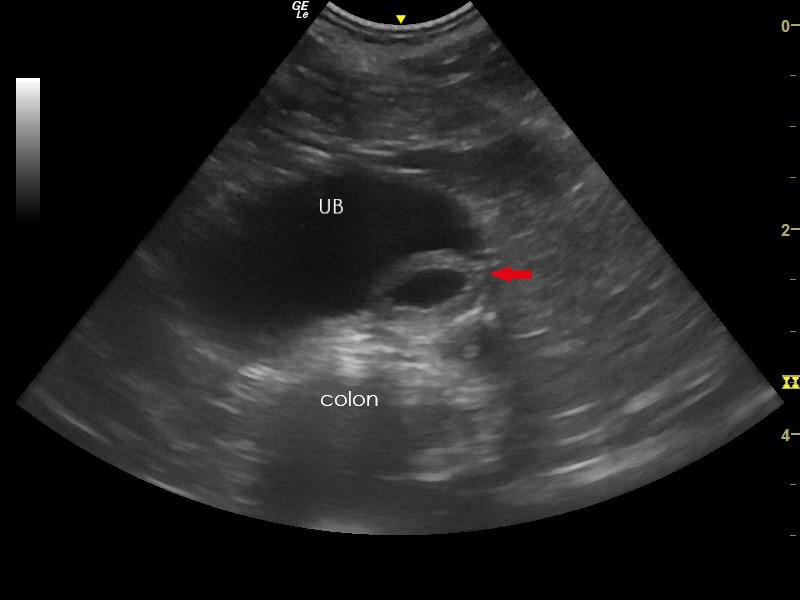Ultrasonography of the Urinary Bladder - ureterocele