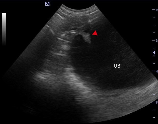 Ultrasonography of the Urinary Bladder - bladder polyp