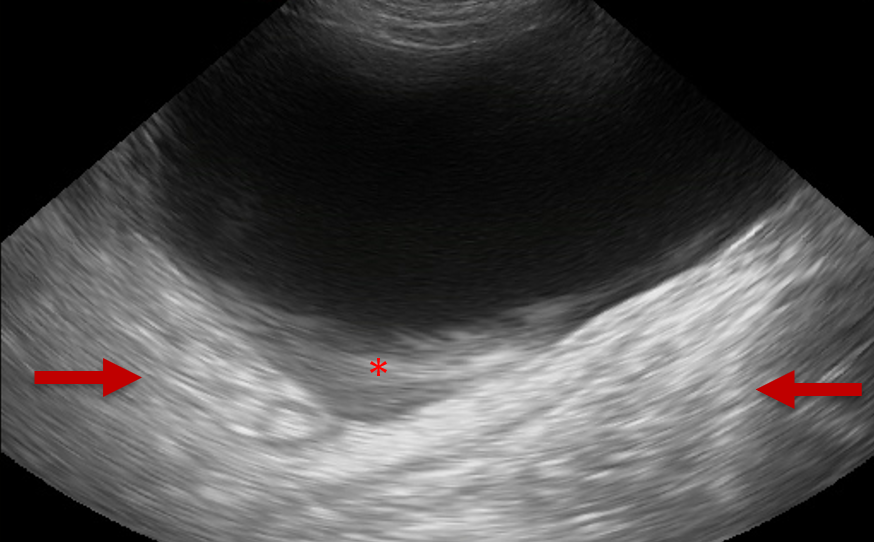 Ultrasonography of the Urinary Bladder - slice thickness artefact