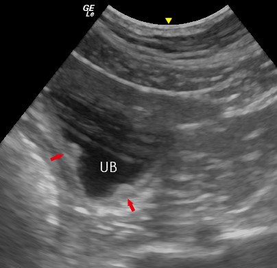 Ultrasonography of the Urinary Bladder - ureteric papillae