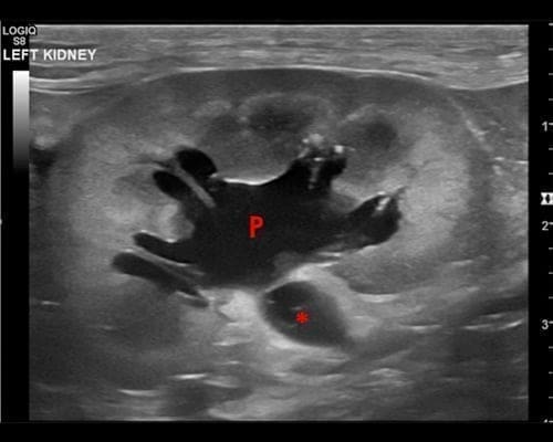 Ultrasonography of the kidneys