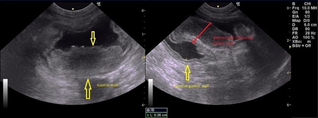 Two ultrasound images showing a transverse section of the stomach.