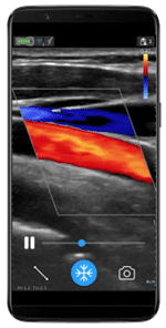 Carotid artery using VScan Air