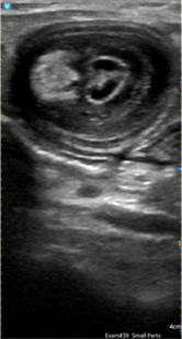 Intussusception using a Vscan Air