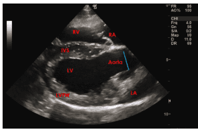 left atrium image