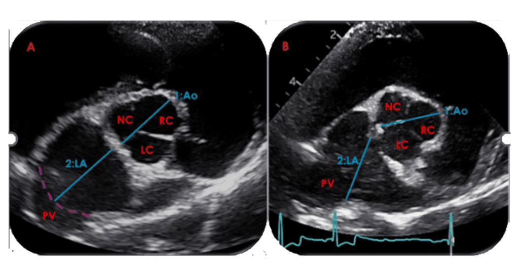 left atrium blog image