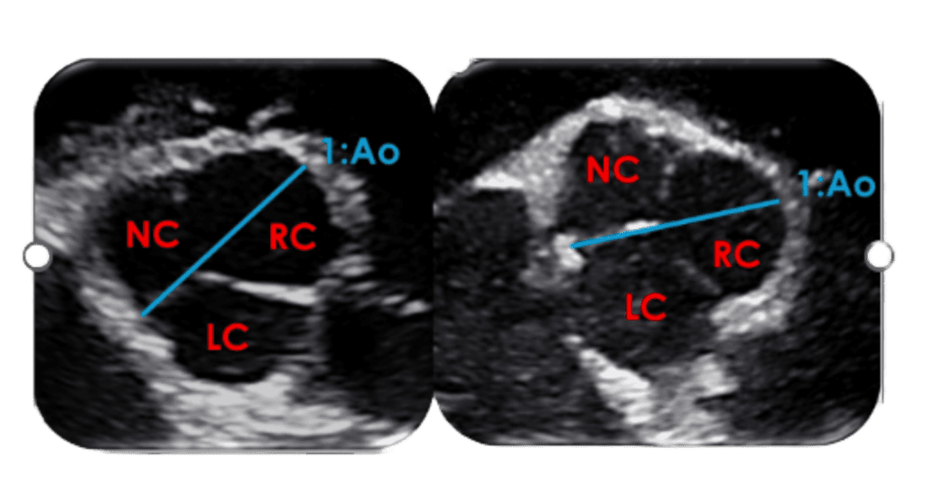 left atrium blog image