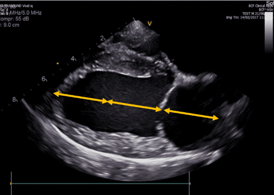 left atrium blog image
