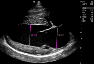 Measuring the left atrium