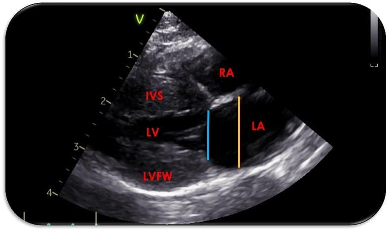 left atrium image